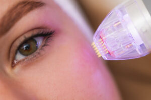 Radiofrekwencja mikroigłowa – Szczecin wybiera inteligentne odmładzanie